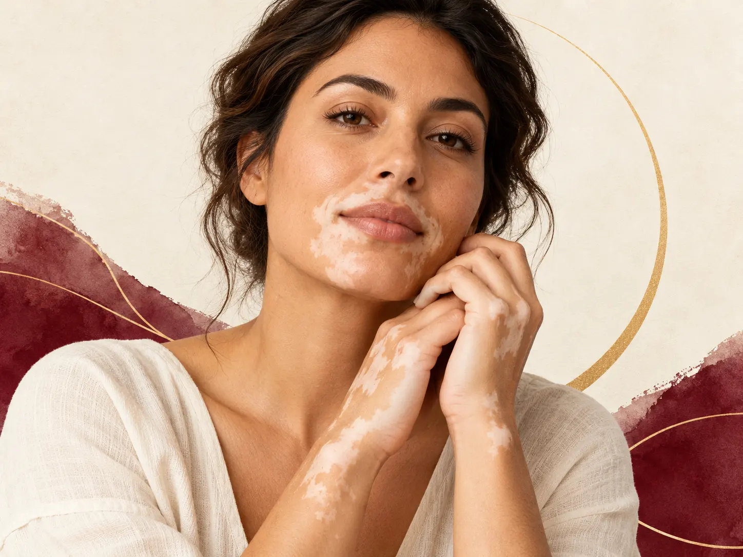 Vitiligo pigmenta zuduma ilustrācija